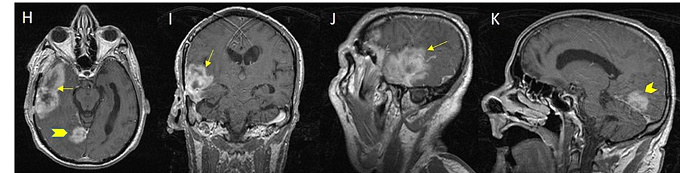 Axial-(H),-coronal-(I)-and-sagittal-(J,-K)-T1-images-from-post-contrast-MRI-demonstrate-an-aggressive-appearing-markedly-heterogenous-large-mass-in-the-right-middle-cranial-fossa-involving-the-right-temporal-lobe-(arrow).-An-additional-separate-lesion-is-seen-adherent-to-the-right-side-of-the-tentorium-(arrowhead).-This-was-found-to-be-a-recurrent-glioblastoma-multiforme-mimicking-as-hemorrhage-before.