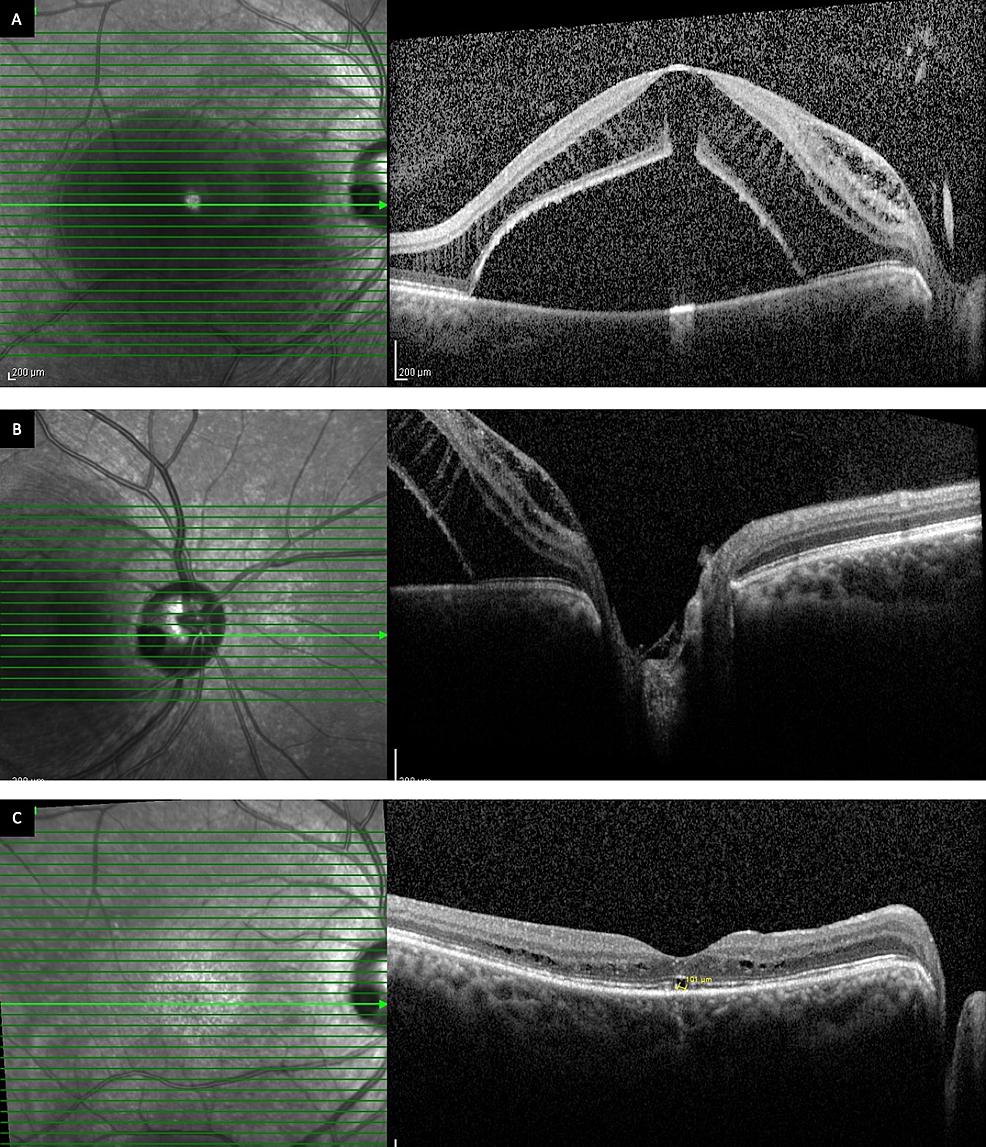 Cureus Optic Disc Pit Maculopathy OneYear of Pars Plana