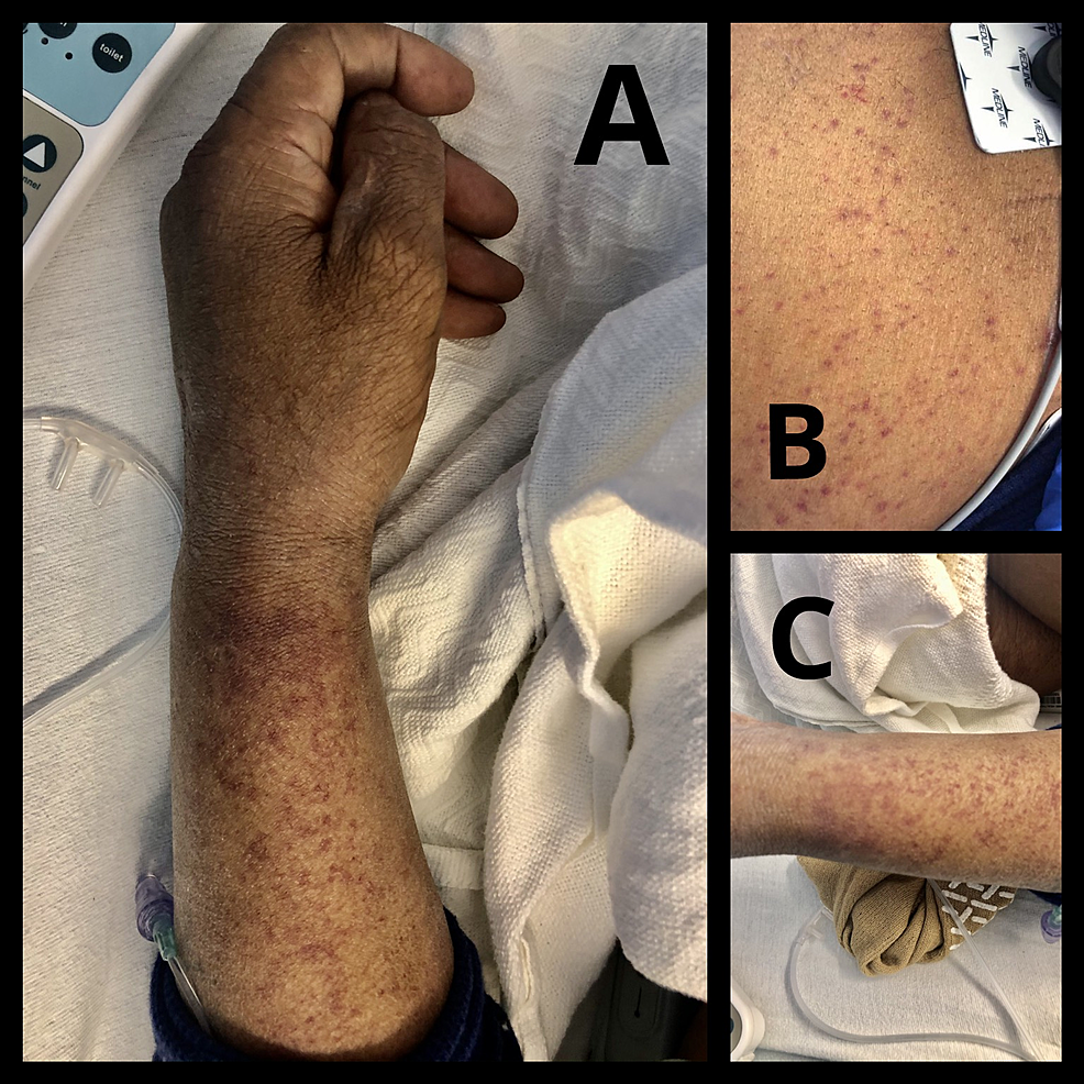 Papular-rash-on-the-left-forehand-(A),-chest-(B)-and-left-leg-(C)-after-receiving-the-COVID-19-mRNA-1273-vaccine.
