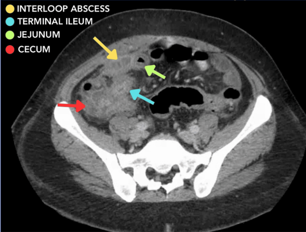 Superior Port Placement in a Patient With an Obstructed Crohn's Disease Flare-Up | Cureus