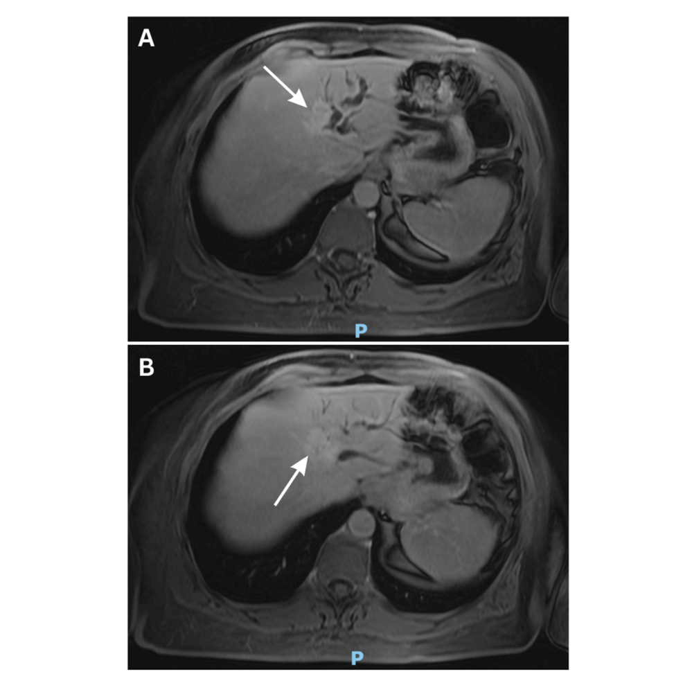 Focal Nodular Hyperplasia Causing Biliary Obstruction and Intrahepatic Gallstones: A Rare Case Study and Literature Review - News Directory 3