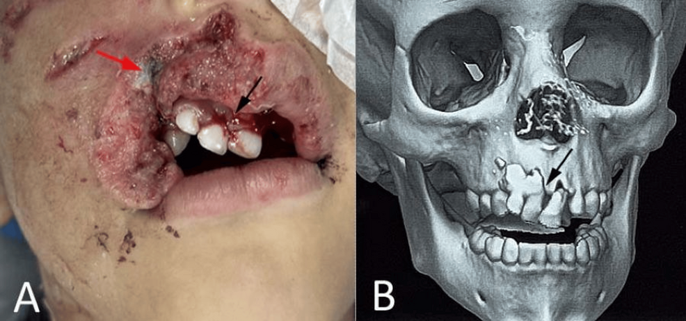 Pediatric Upper-Lip Avulsion Reconstructed With an Abbé Flap Following a Dog Bite