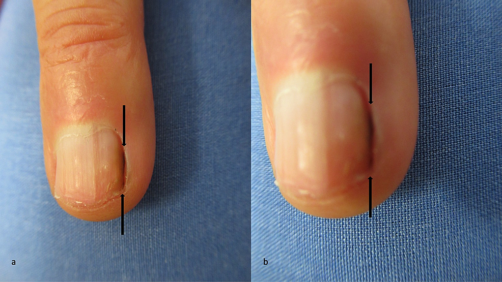Representative images of differential diagnoses of nail apparatus... |  Download Scientific Diagram