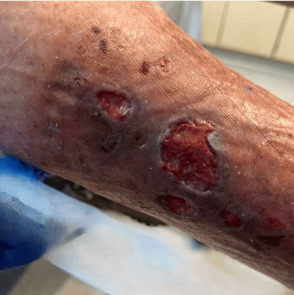 Recurrent Great Saphenous Vein Reflux After Prior Endovenous Laser Therapy: Diagnostic and Management Challenges in Chronic Venous Insufficiency