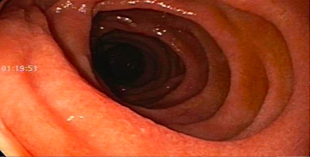 Upper-endoscopy-of-3rd-portion-duodenum-with-normal-duodenal-mucosa