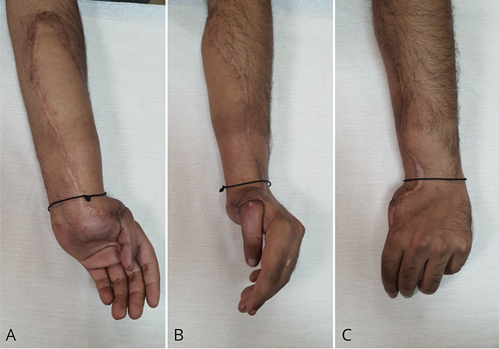 Cureus Epithelioid Sarcoma Of Upper Extremity Diagnos - vrogue.co