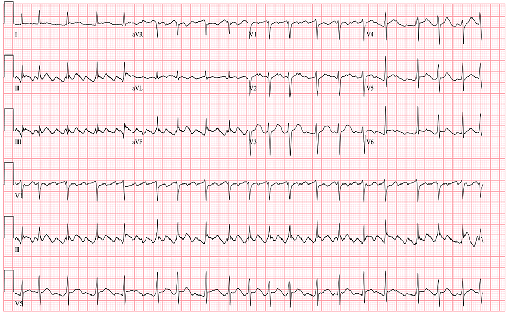 Cureus | A Case of Atrial Flutter Masking Acute Pericarditis