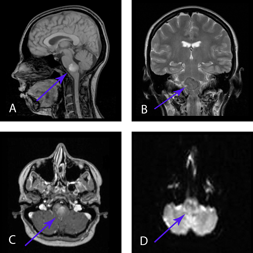 Double intraspinal enterogenous cysts.