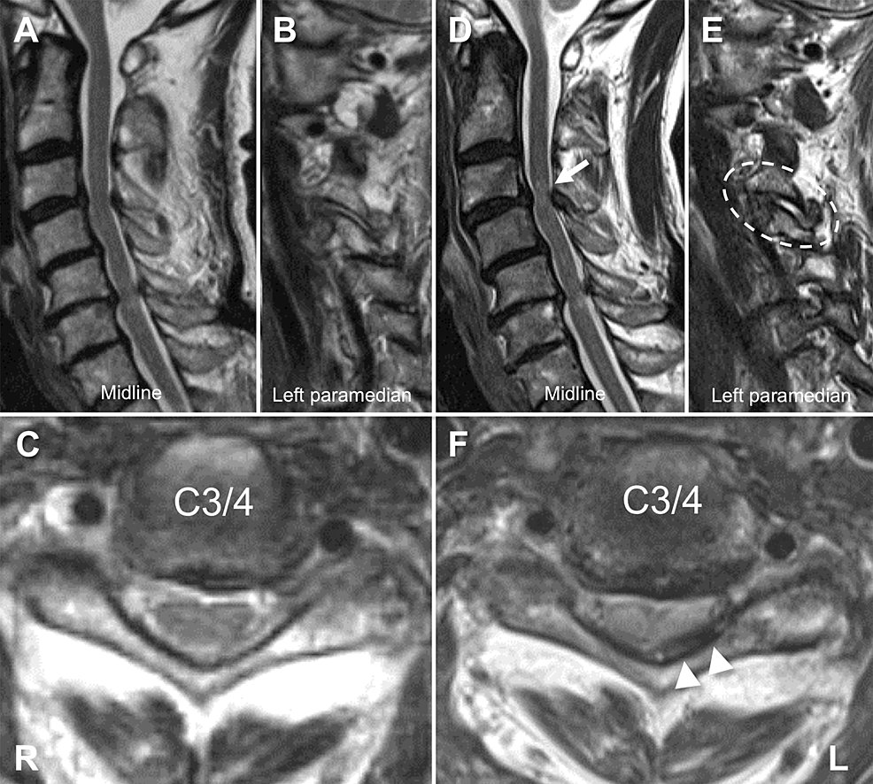 Cureus, Brainstem and Spinal Arachnoiditis Ossificans Associated With  Neurocysticercosis: A Case Report