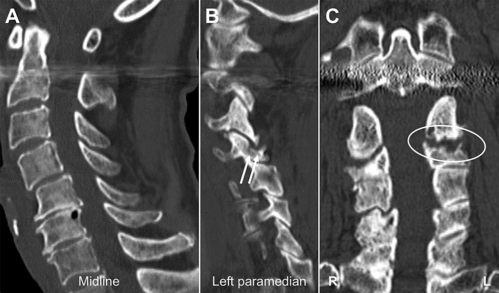 Cureus Unilateral Degenerative Facet Joint Pathology Eliciting