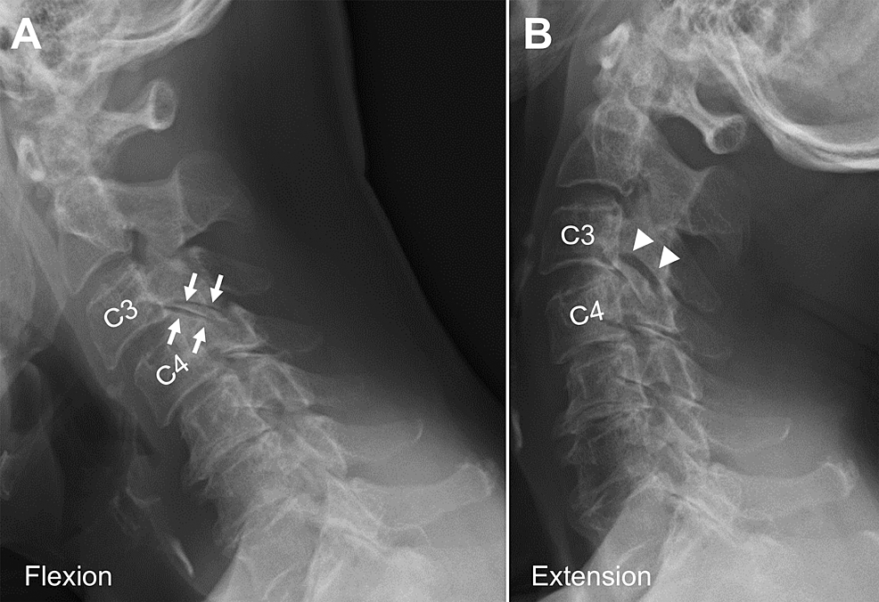 Cureus Unilateral Degenerative Facet Joint Pathology Eliciting