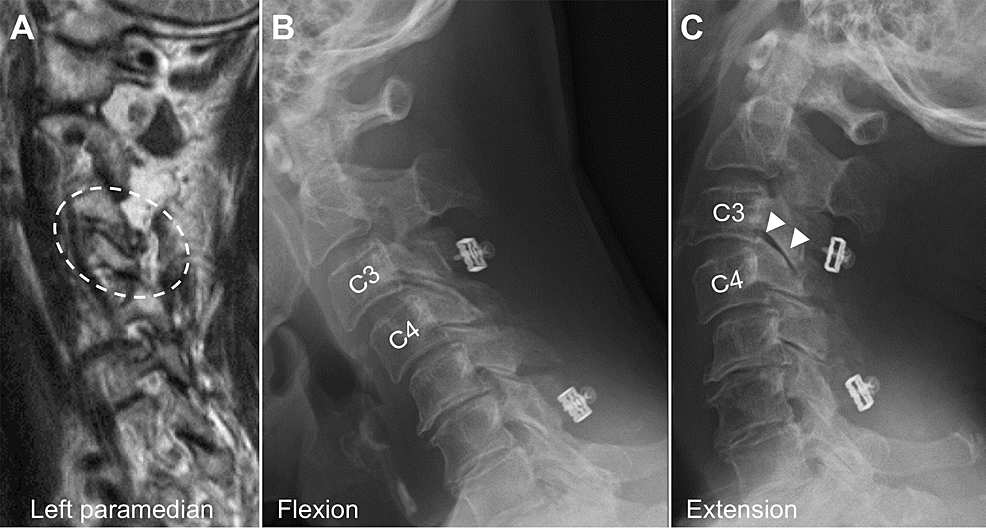 Cureus Unilateral Degenerative Facet Joint Pathology Eliciting