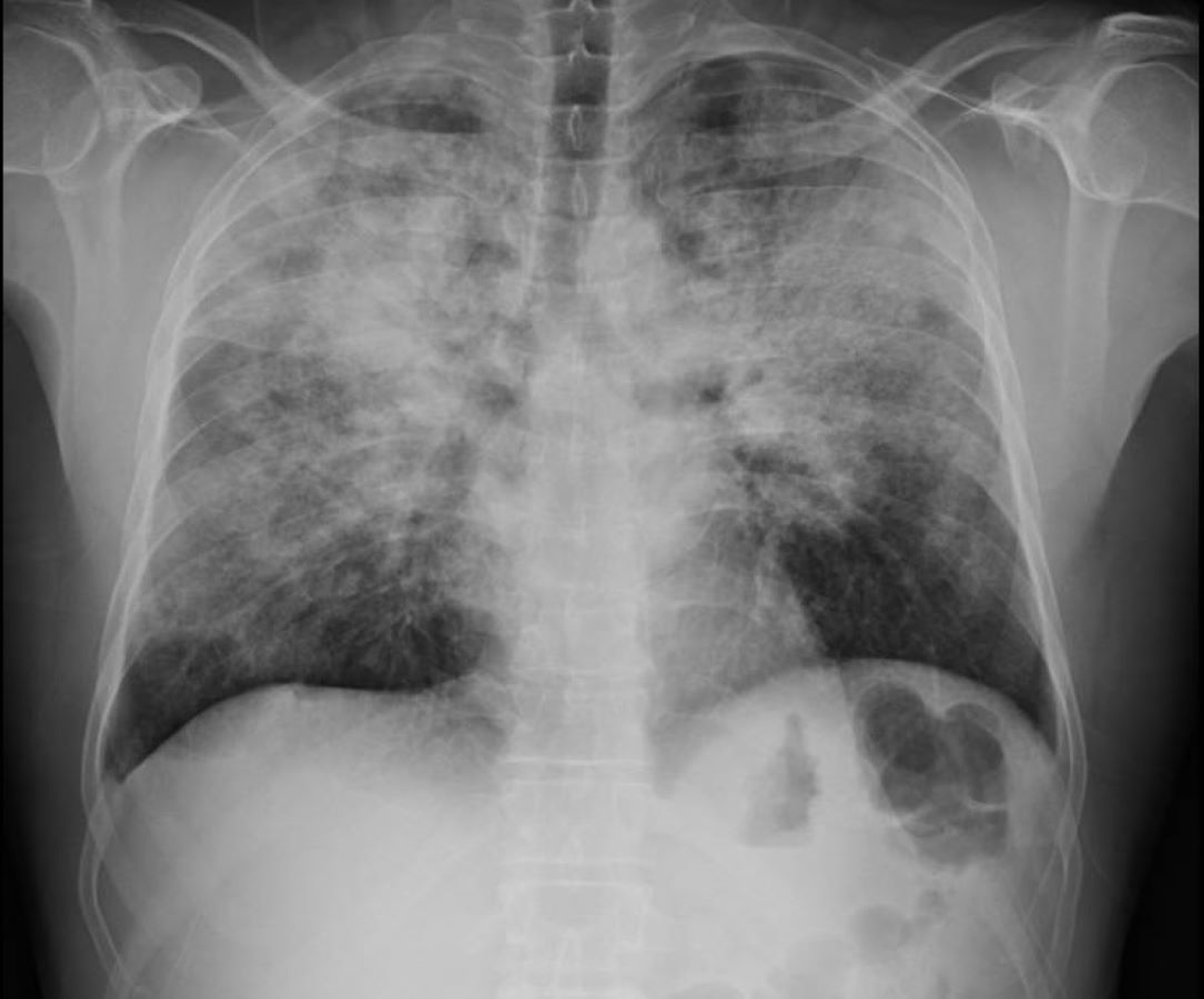 eosinophilic-pneumonia