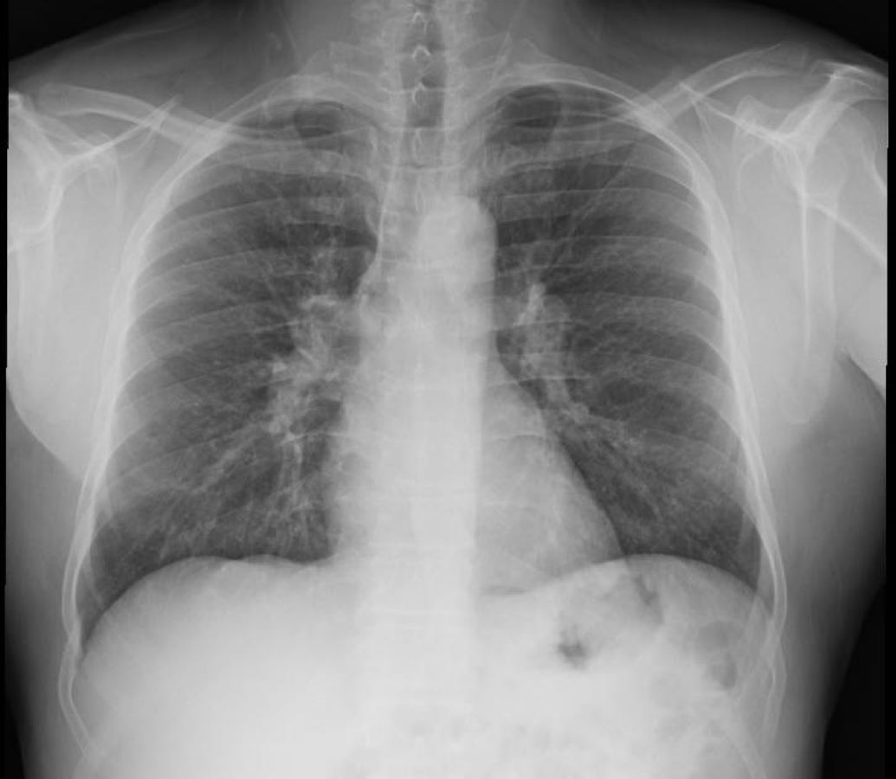 Cureus | Idiopathic Chronic Eosinophilic Pneumonia