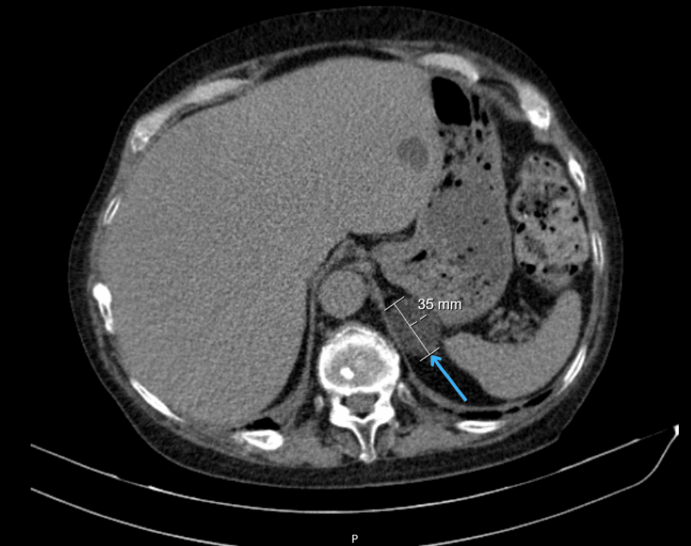 Abdominal-computed-tomography-scan-showing-left-adrenal-mass