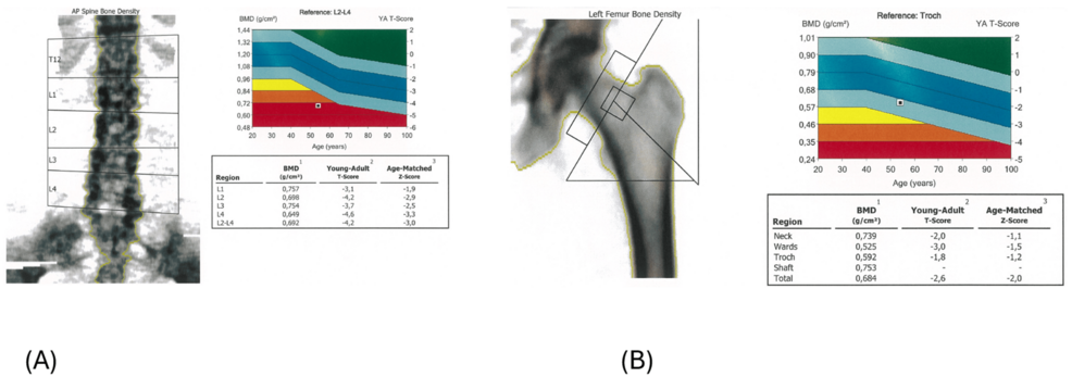 Bone-densitometry-showing-severe-osteoporosis