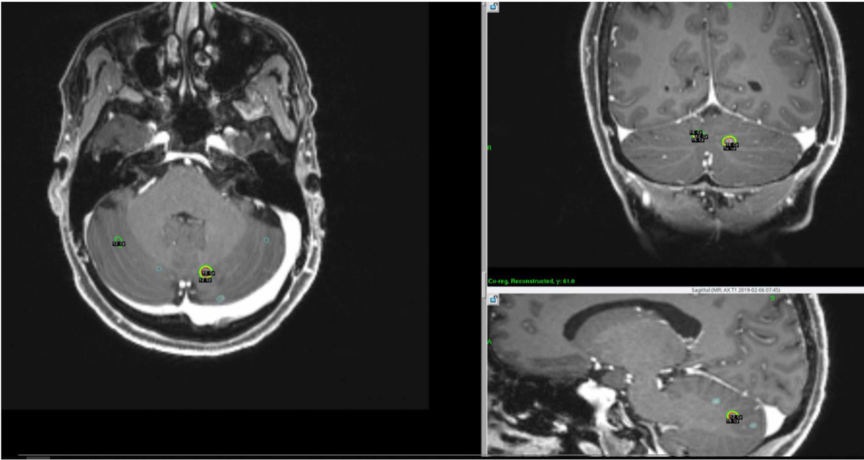 Cureus Expanded Radiosurgery Capabilities Utilizing Gamma Knife Icon