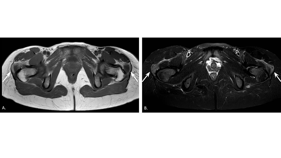 MRI-axial-T1-(A)-and-T2-(B)-images-of-the-bilateral-lower-extremities-during-dermatomyositis-flare-on-nivolumab-therapy.-Muscle-edema-in-the-bilateral-gluteus-minimus-and-gluteus-medius-muscles-was-noted.