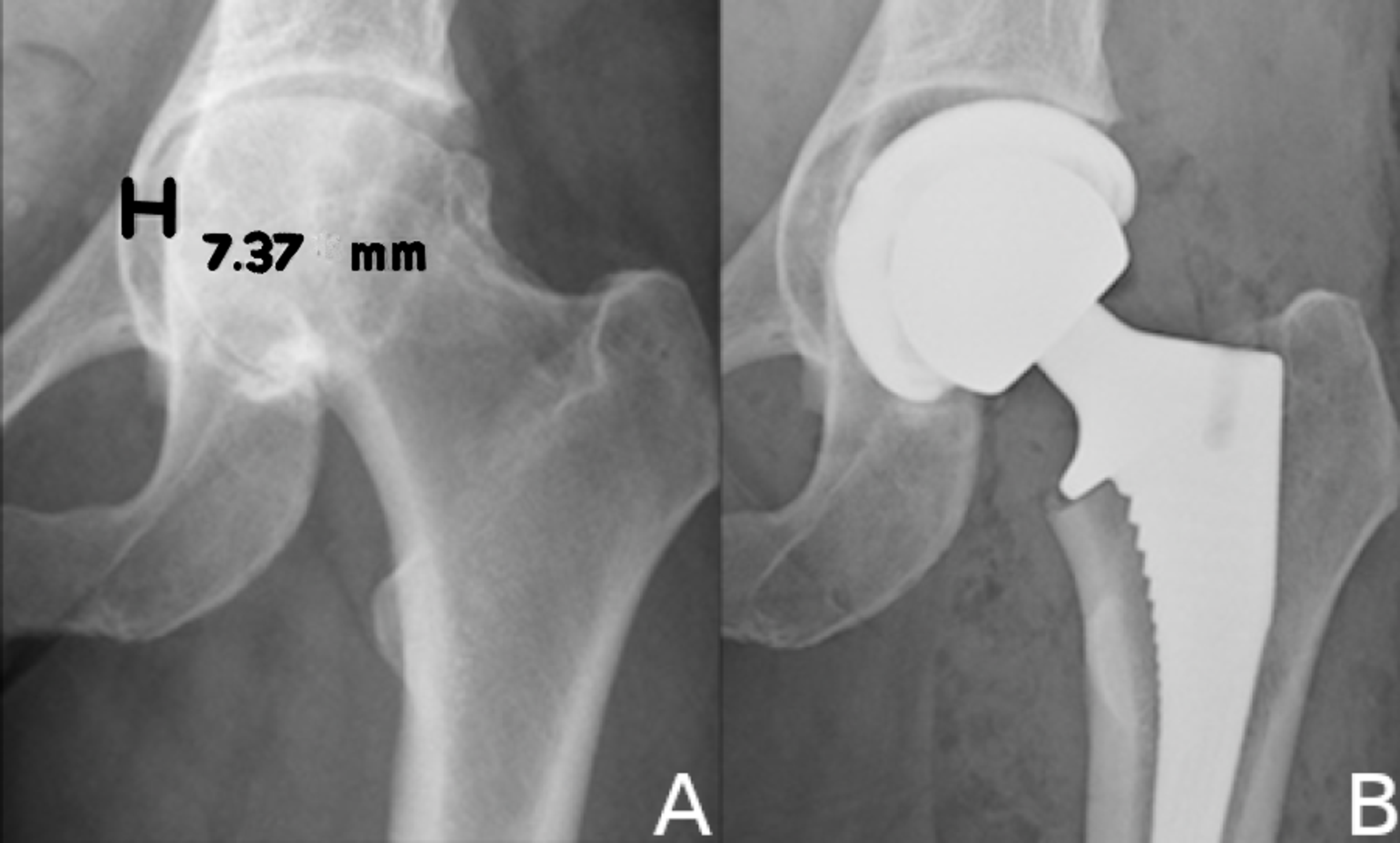 Cureus Managing Protrusio Acetabuli With A Direct Anterior Approach Total Hip Replacement 2110