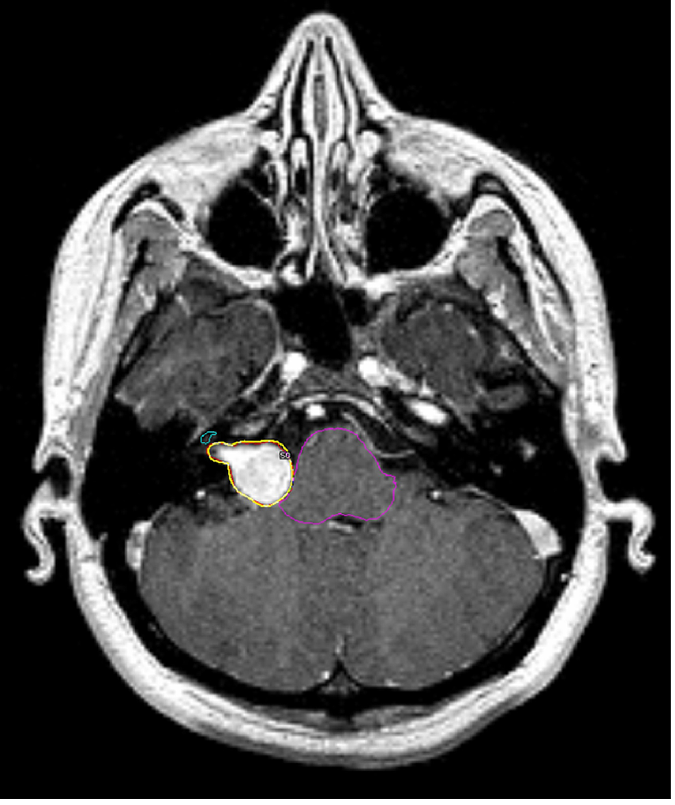 Diffusion Tensor Imaging Features of the Auditory Pathways in Patients