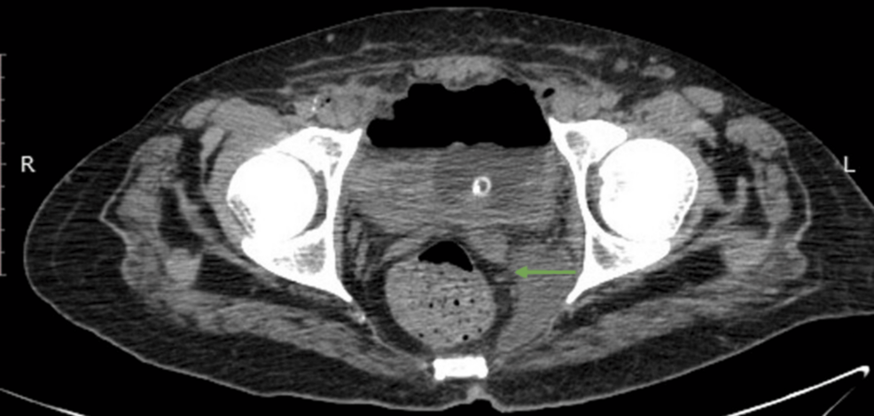 Successful Conservative Management of Emphysematous Cystitis Following COVID-19 Infection - Cureus - News Directory 3