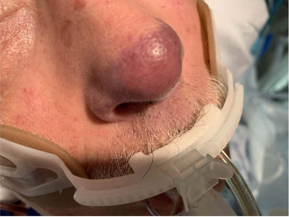 A Bite So Bad: Septic Shock Due to Capnocytophaga Canimorsus