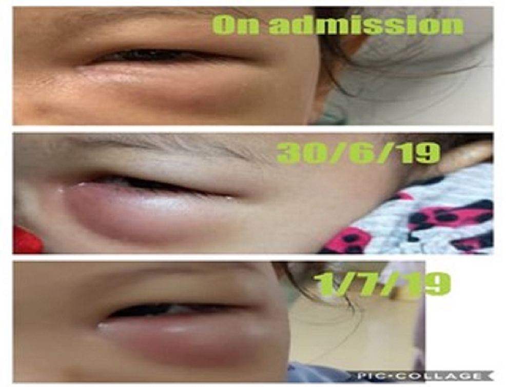 The-progression-of-the-left-periorbital-swelling.-The-condition-worsened-on-day-3-after-admission.