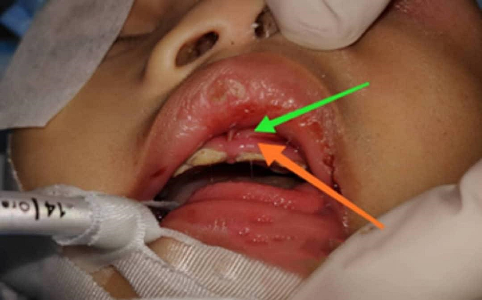 Upper-gum-swelling-with-abscess-collection.
