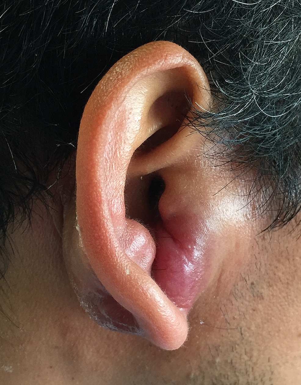 Right-earlobe-mass.