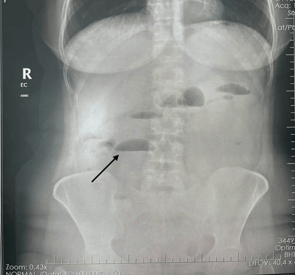Abdominal Cocoon Syndrome Masquerading as Intussusception on Computed Tomography: A Case Report