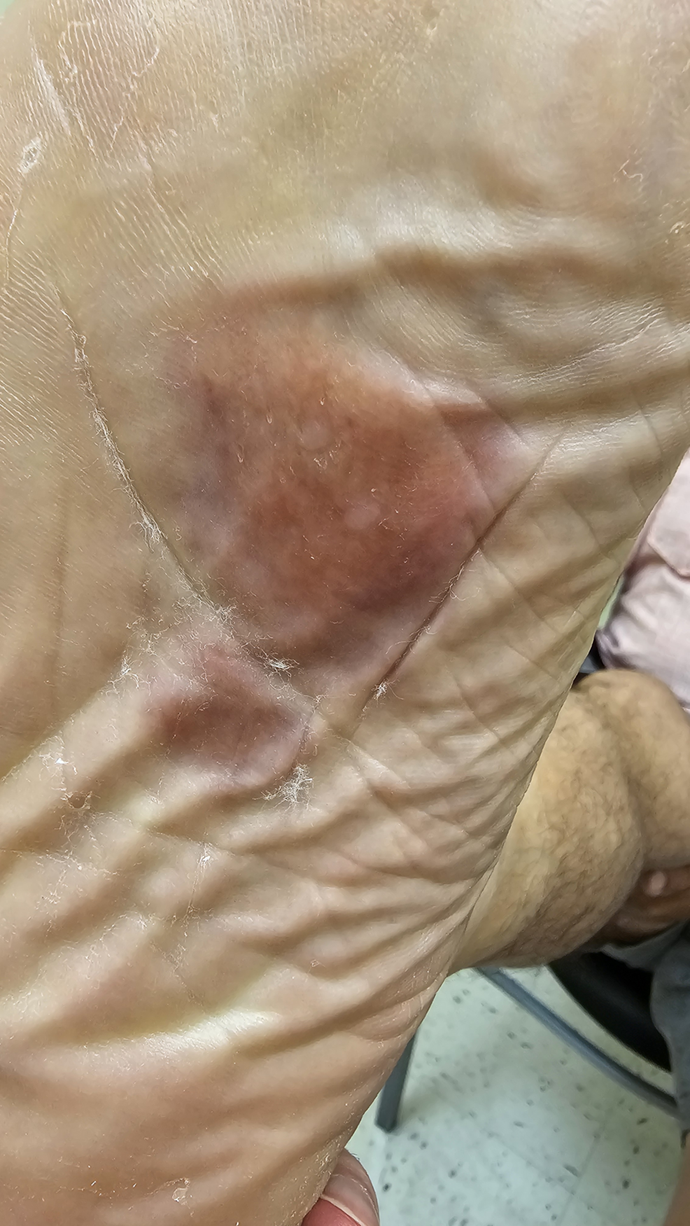 Primary Cutaneous Nodular Amyloidosis Presenting as Violaceous Plantar Patches