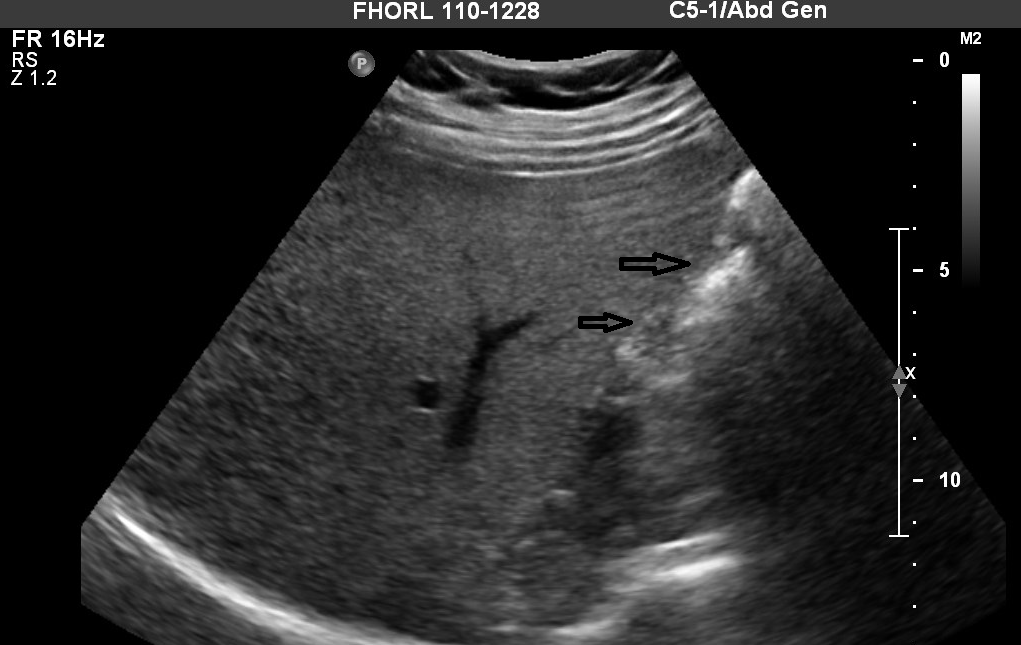 Gallbladder Ultrasound