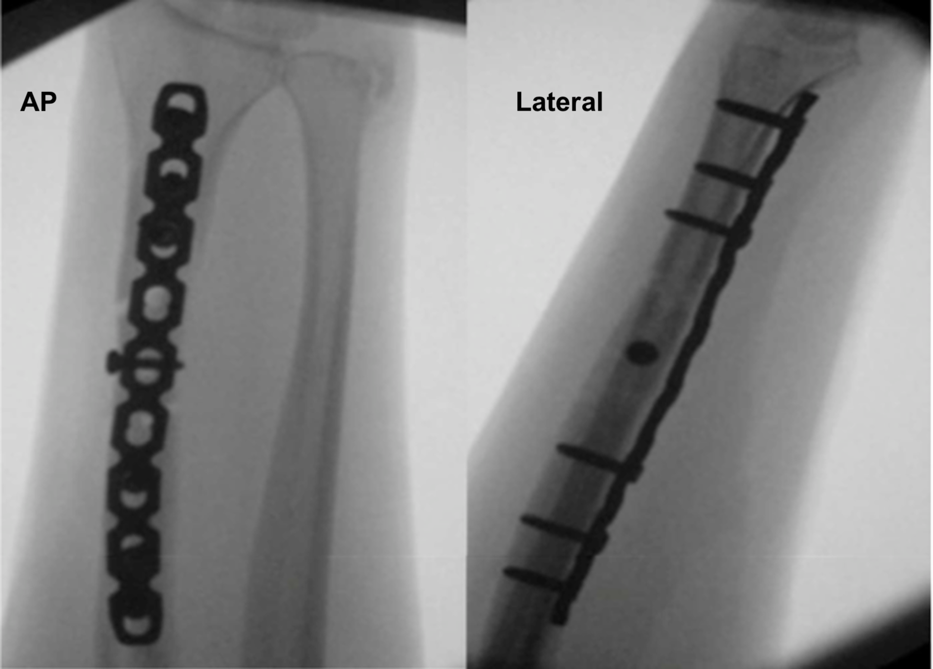 galeazzi fracture bone stimulator