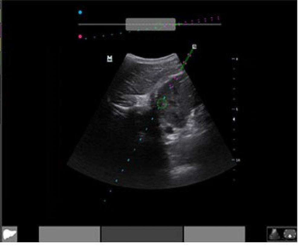 Twinkle artifact of renal calculi | Radiology Case | Radiopaedia.org