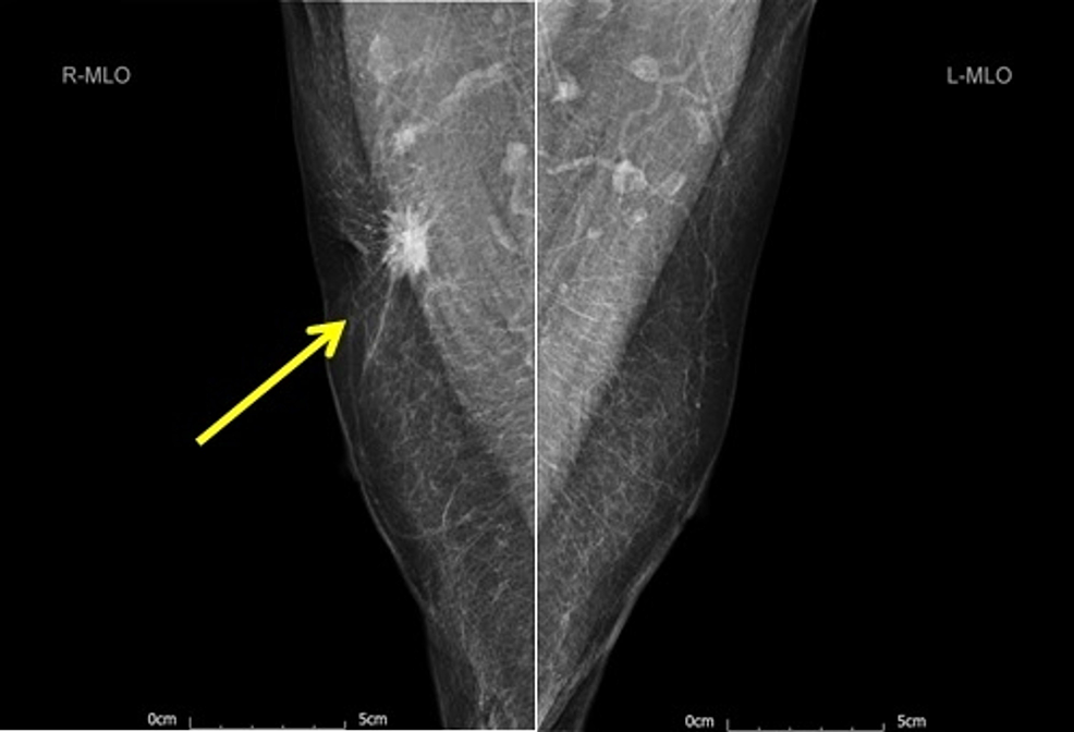 Bilateral-mammogram-(mediolateral-oblique-view)-showing-a-25-mm-suspicious-lesion-in-the-right-breast-axillary-tail-(yellow-arrow).
