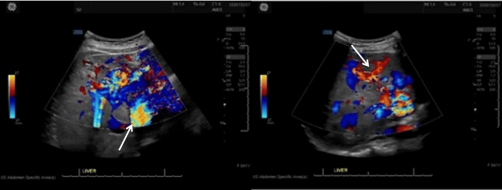 When Phenotype Outspeaks Genotype: Uncommon Vascular Anomalies in Suspected Hereditary Hemorrhagic Telangiectasia Despite Negative Genetic Testing