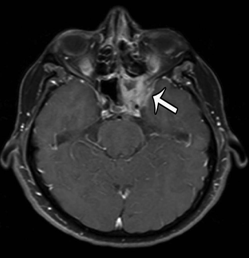 Radiology Sinusitis