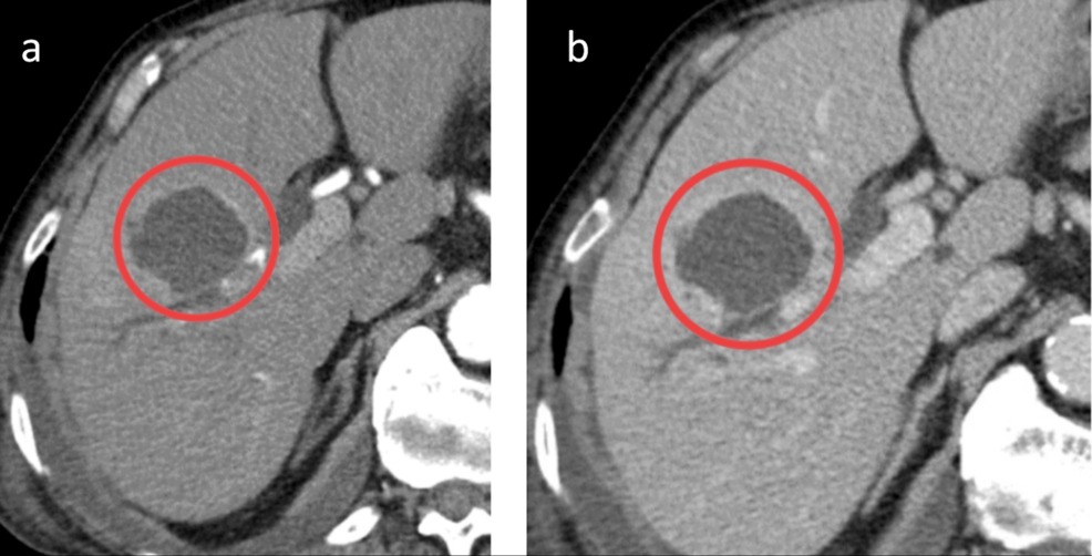 Septic Shock Due to Liver Abscess Complicated by Recurrent Heart Failure Exacerbation in a Patient Diagnosed With Heart Failure With Preserved Ejection Fraction (HFpEF)