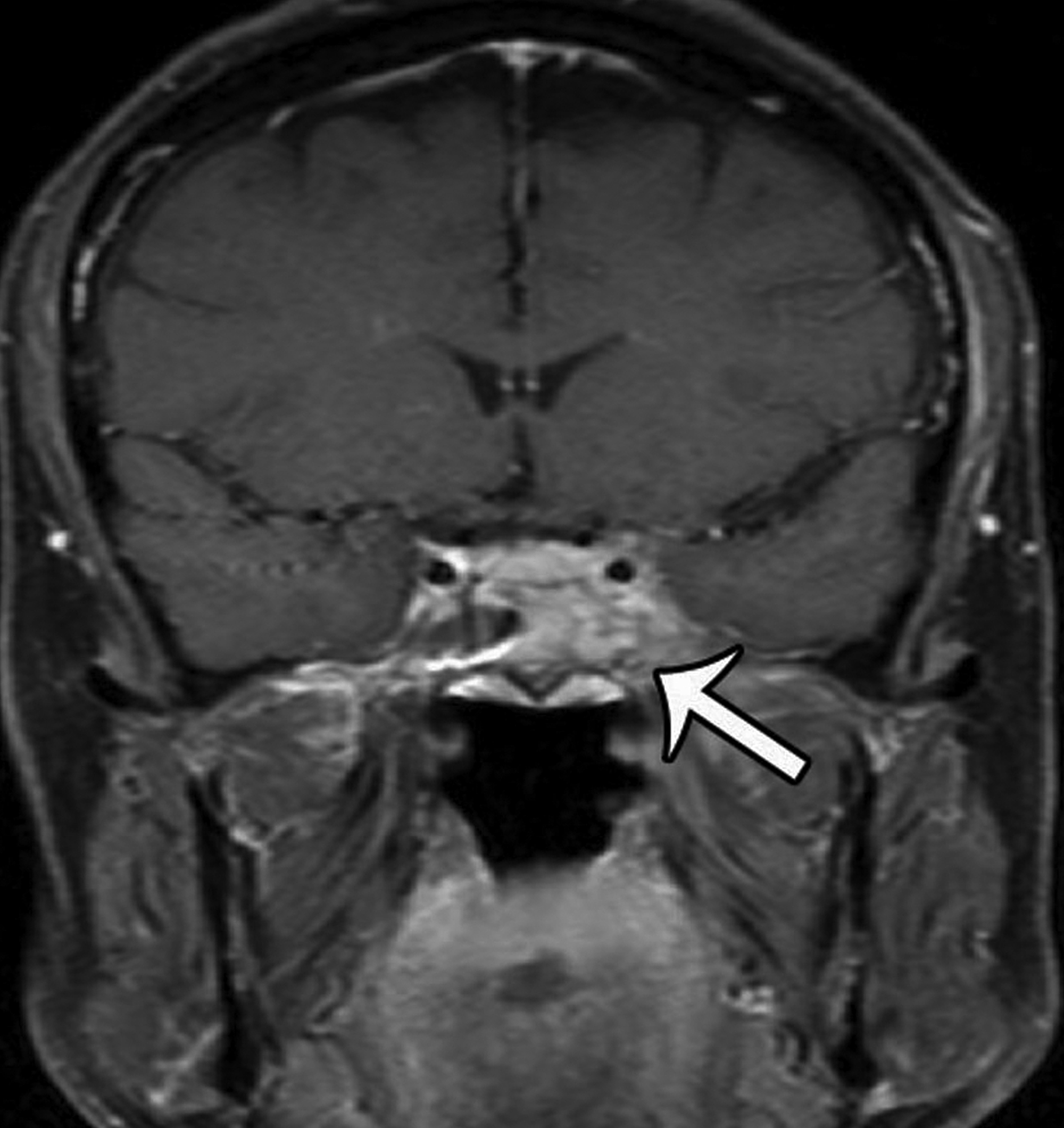 Cureus | Inflammatory Myofibroblastic Tumor of the Left Sphenoid and ...