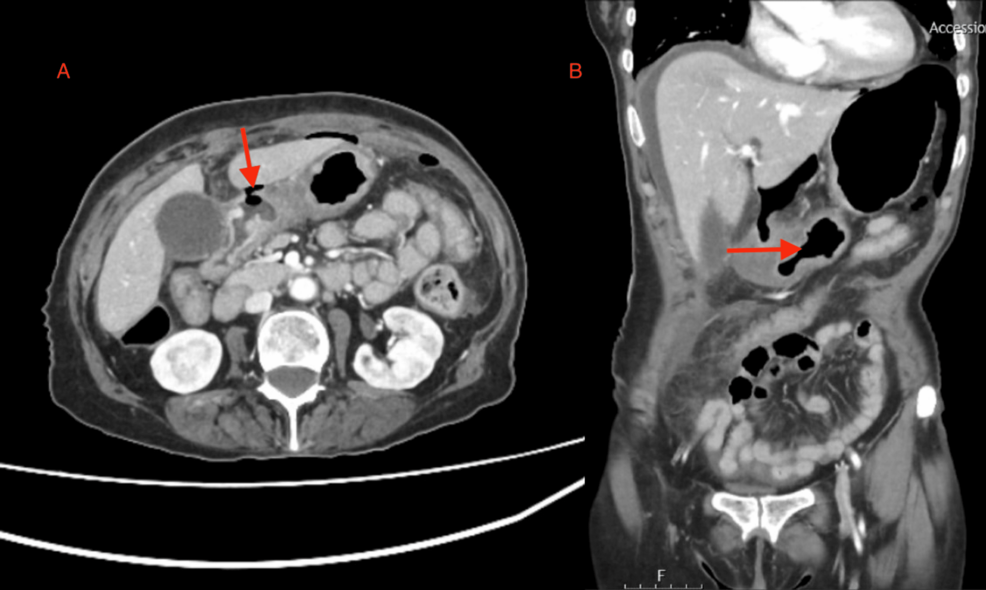 Early Postoperative Endoscopic Findings Following Oversewn Repair of Prepyloric Ulcer Perforation: A Case Report