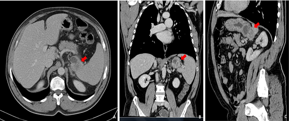 Cureus | Pancreatobiliary Adenocarcinoma in a Gastric Duplication Cyst ...