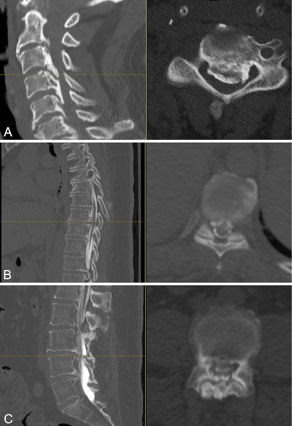 Cureus | Ossification Of The Posterior Longitudinal Ligament In The ...