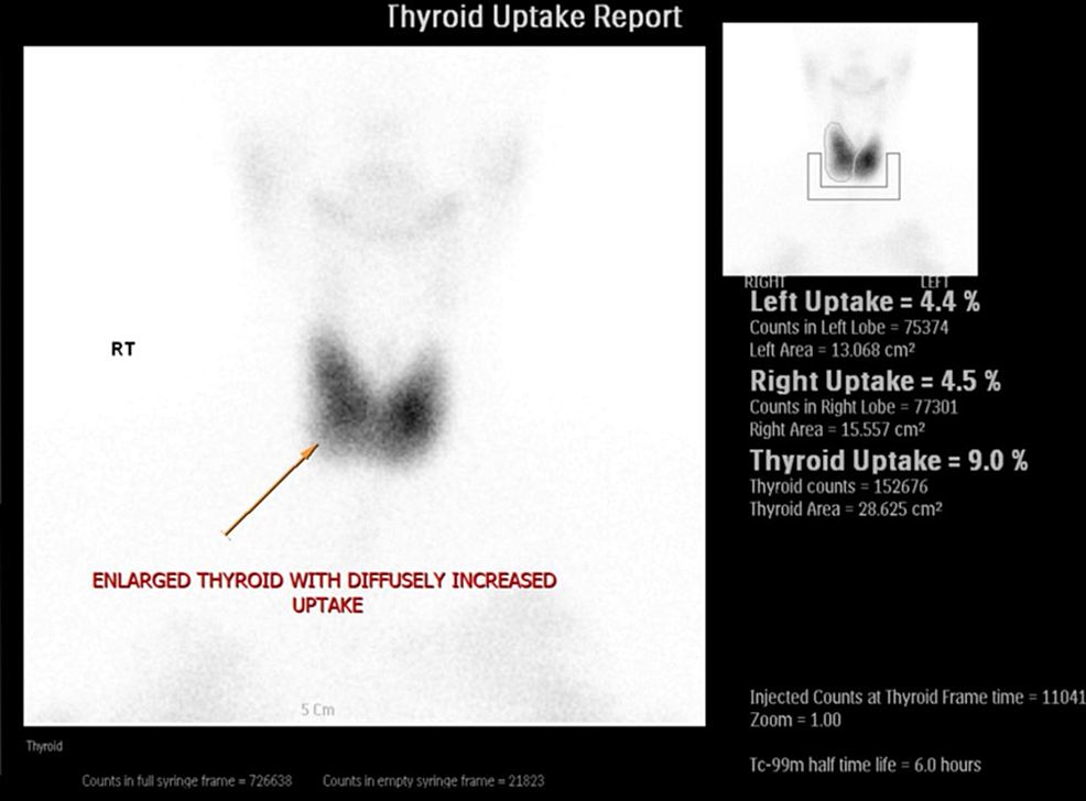 Cureus | A Uniquely Challenging Case of Poorly Controlled