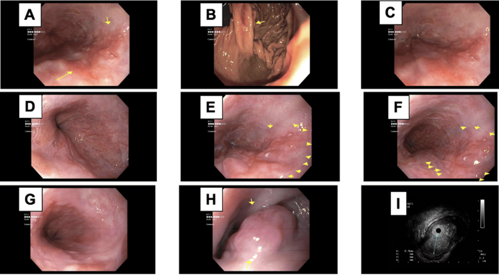 smoking cigarettes before colonoscopy reddit Vaping Surgery: Risks and Considerations Severe Crohn's Disease With Intra-abdominal