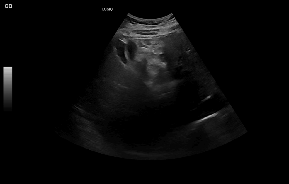 Incidental Gallbladder Duplication Detected on Imaging: A Case Report