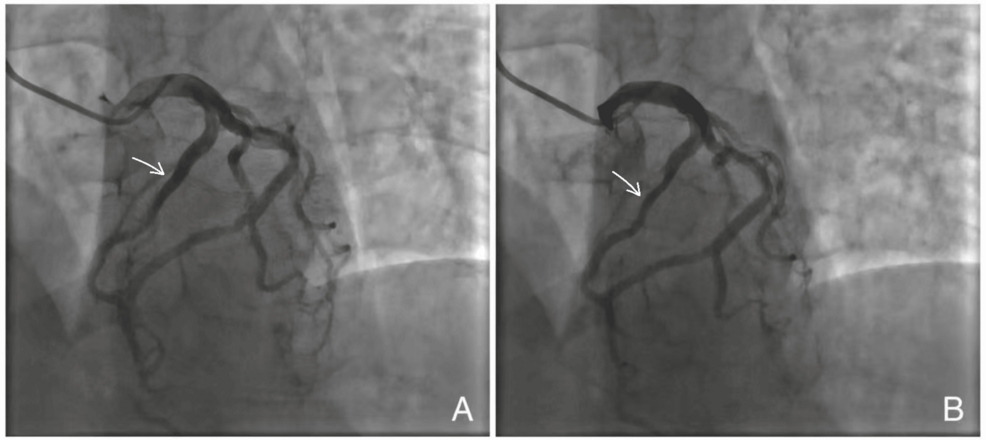 Apparent Longitudinal Variation in the Angiographic Expression of Myocardial Bridging: Reduced Dynamic Left Anterior Descending Artery Compression With Newly Detected Distal Left Circumflex Artery Bridging on Long-Term Follow-Up