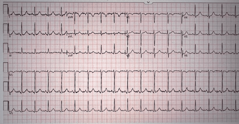Twelve-lead-electrocardiogram-(EKG)-demonstrating-sinus-tachycardia-at-a-ventricular-rate-of-104-BPM,-with-a-PR-interval-of-114-ms,-QRS-duration-of-70-ms,-QTc-of-441-ms,-and-P-R-T-axis-of-54/49/39°,-confirmed-as-otherwise-normal-EKG.-This-was-obtained-following-troponin-elevation-of-0.064-ng/mL-in-the-setting-of-hemorrhagic-shock-secondary-to-gestational-trophoblastic-disease