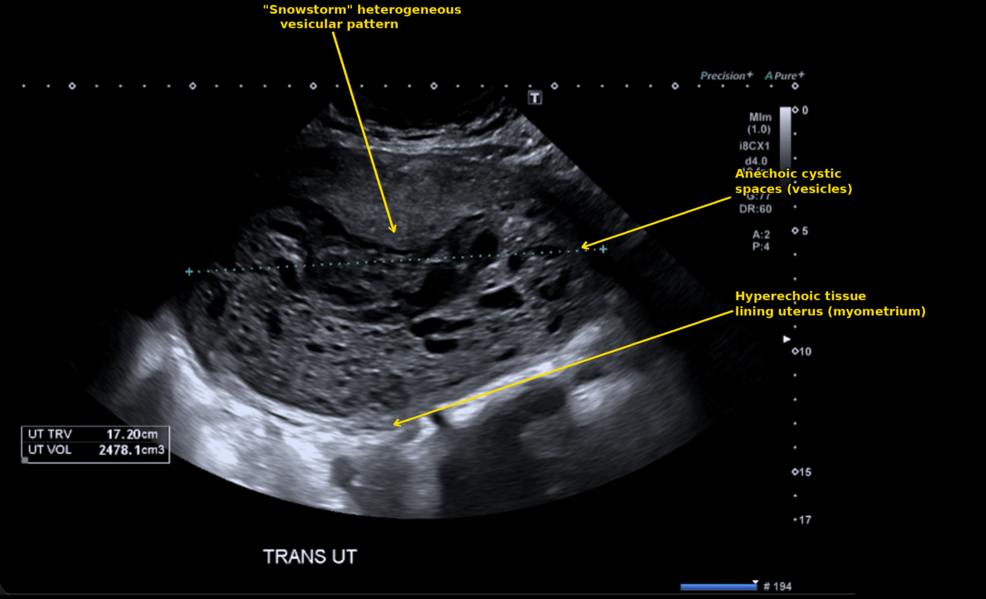 Transvaginal-ultrasound-demonstrating-a-markedly-enlarged-uterus-(22.6×12.2×17.2-cm)-with-a-heterogeneous-echogenic-intrauterine-mass-showing-the-classic-"snowstorm"-appearance,-with-mildly-thickened-endometrium-extending-into-the-myometrium,-consistent-with-gestational-trophoblastic-disease