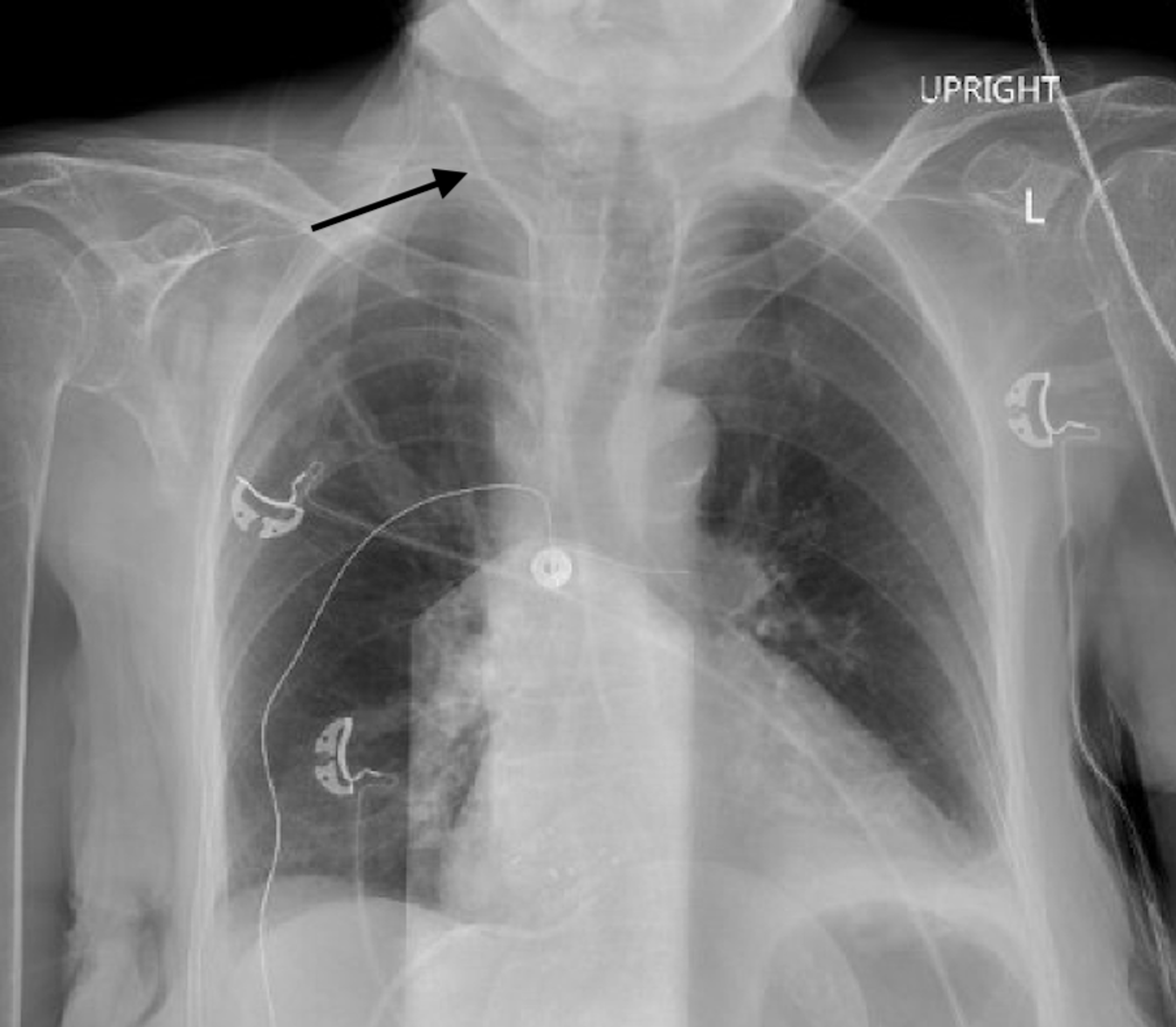 Cureus | Subclavian Artery Injury Following Central Venous Catheter ...