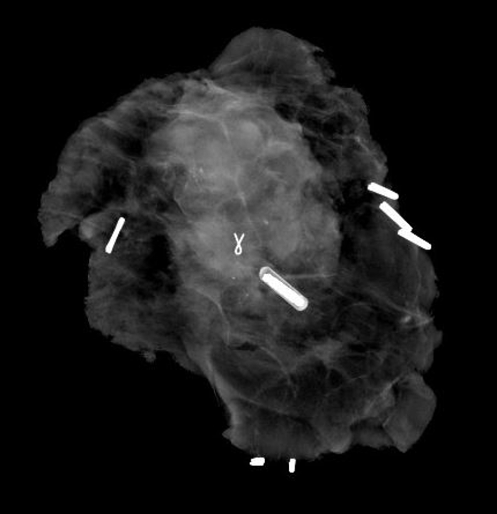 Cureus Breast Cancer in the Presence of Failed Saline Breast Implants